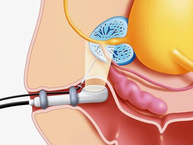 Biopsie de perforation de la glande de la prostate