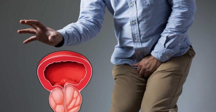 Prévention de la prostatite et de l'adénome de la prostate